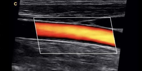 Chison Ebit 30 Color Doppler Ultrasound Scanner with Linear Array Probe 7-18MHz