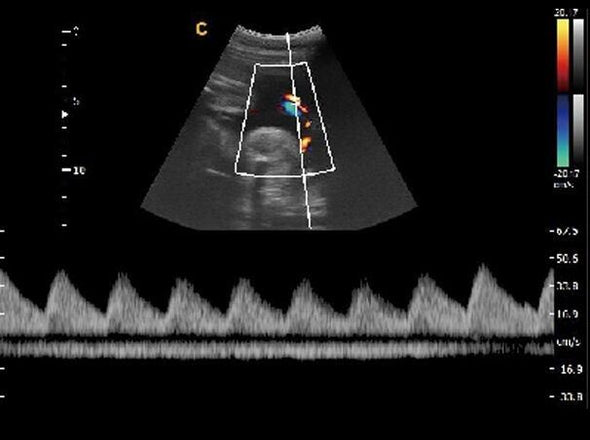 Chison Ebit 30 Color Doppler Ultrasound Scanner with Linear Array Probe 7-18MHz