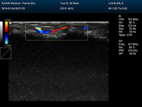 Newest- Color Portable Ultrasound & One Probe, DICOM, LED screen