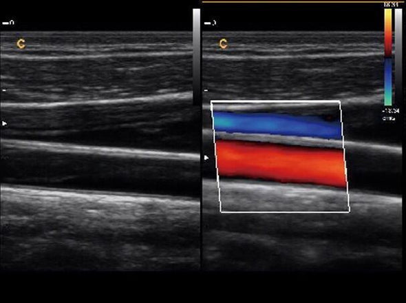 Chison Q5 Color Doppler Ultrasound Scanner With one linear array probe